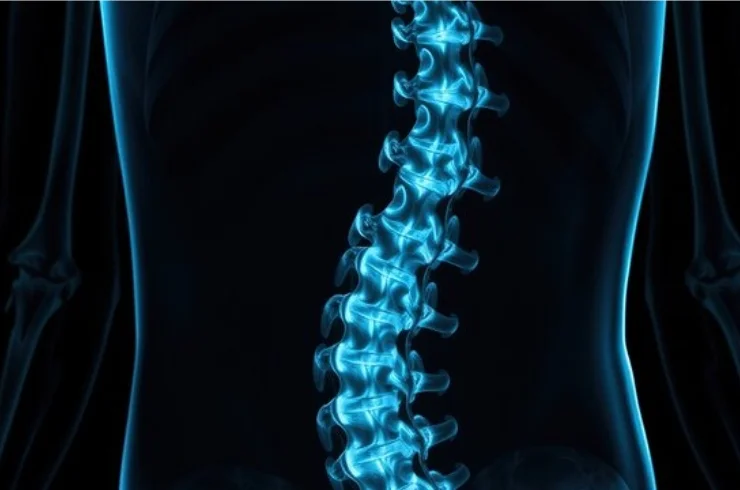 Lumbar Spondylitis------13